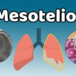 Descubre las causas del mesotelioma en solo 3 minutos