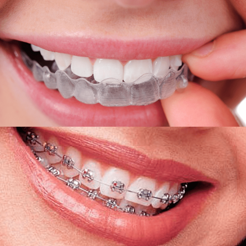 Descubre cuánto cuesta un aparato dental y cómo elegir la mejor opción para tu salud bucal