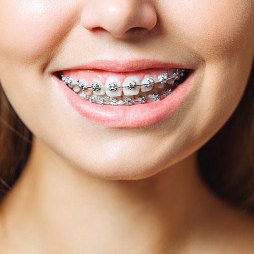 ¿Qué es un retenedor y cuál es su importancia para la salud dental?